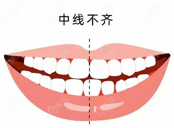 牙齿出现中线不齐的情况