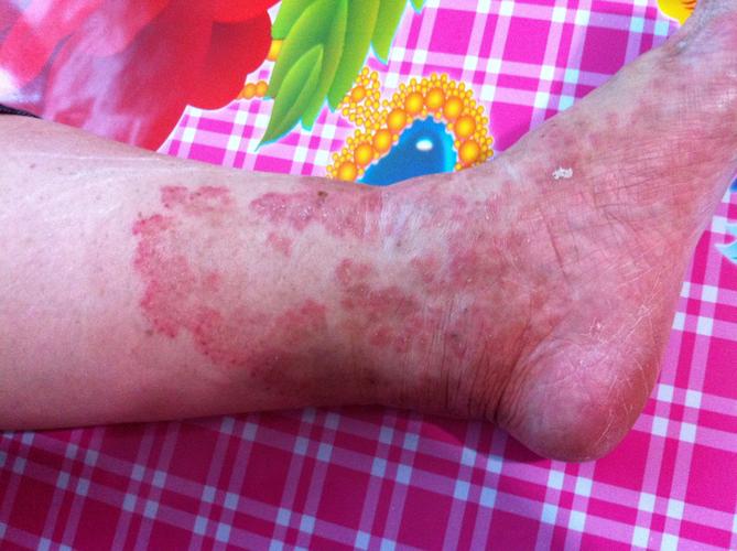 我奶奶七十六岁,有糖尿病,腿上,脚上这是什么癣,奶奶说很痒,什么方法