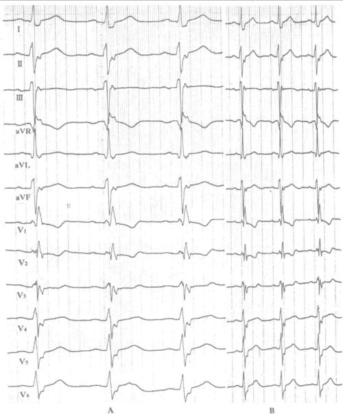 右束支阻滞加左前分支阻滞-12导联心电图同步诊断学