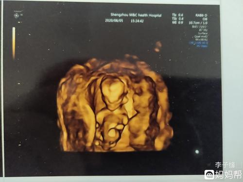 这是14周男宝宝和女宝宝***图片!宝!