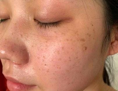 28岁女子皮肤长斑不重视确诊肝癌医生叹息2个习惯要不得