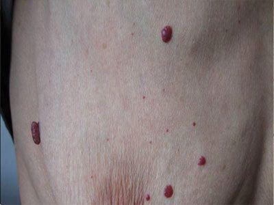 什么方法治疗血管瘤的效果好_血管瘤_北京京城皮肤病