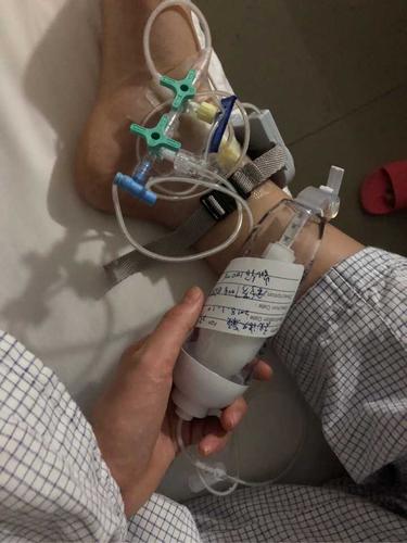 磨骨啊…从恢复期就可以反推疼痛感 术后镇痛棒也许是减轻了痛感 但是