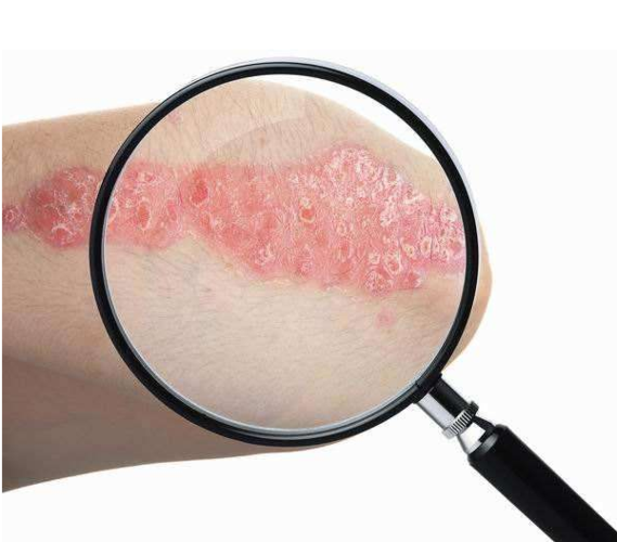 体癣是由毛发癣菌,小芽孢菌或表 皮癣 菌引起.