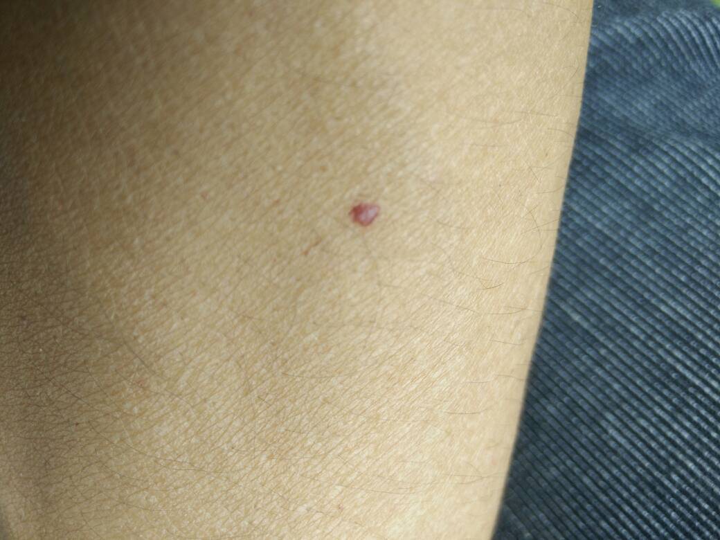 医师来自南京大学医院 答: 看图如果很红考虑樱桃样血管瘤,一般不长大