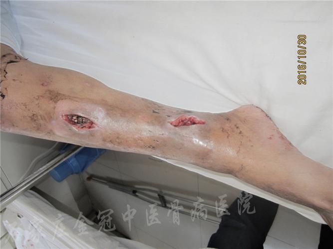 广东普宁林先生胫骨骨髓炎就是这样治好的!