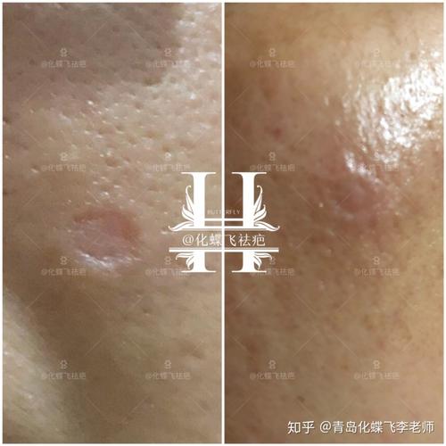凹陷疤痕可以修复吗?