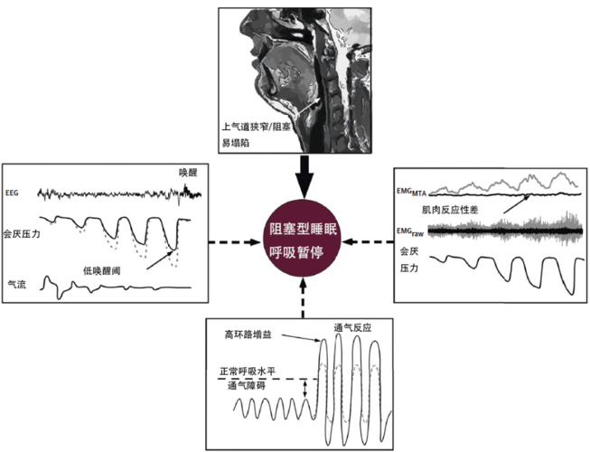 目前主要将该病理状态分为两型: 阻塞型睡眠呼吸暂停与中枢型睡眠