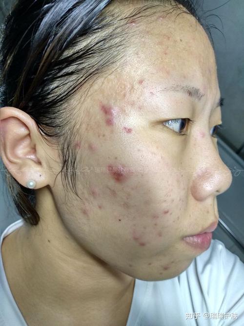 为什么迄今为止痘痘(痤疮)没有被攻克?