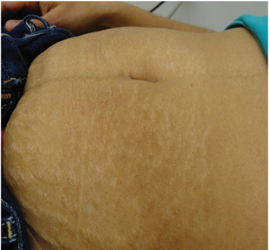 腹部生长成熟的红色膨胀纹,图片来源int j womens dermatolv