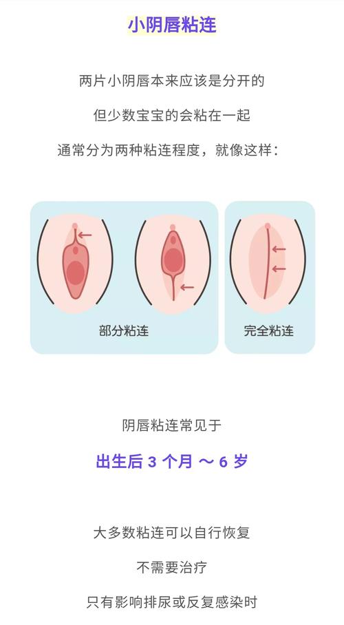 女宝宝阴部总有