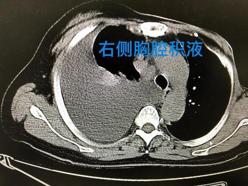 呼吸系统疾病之胸腔积液篇