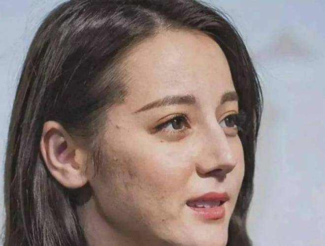 她的脸颊已经出现了明显的坑坑洼洼,大大小小的闭口非常"瞩目",在路人