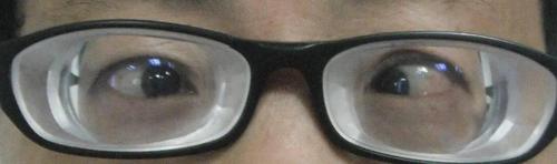 近视眼的眼轴长度会大于这个正常值,眼轴每增加1mm,近视度数增长300