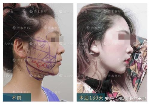 颧弓口角面颊下颌缘吸脂