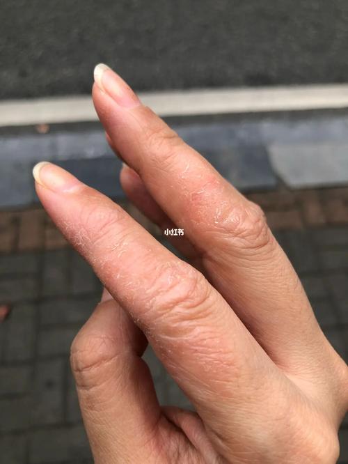 手湿疹太惨了,快5年了反复不好_湿疹_免疫力_洗手液_中药_伤口愈合