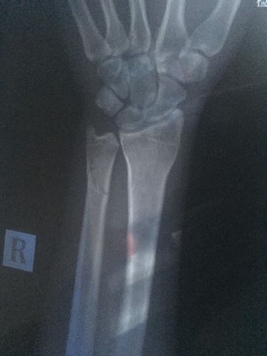 右手尺骨远段骨折,36岁,20天了,现在夹板自己拿了,也能稍微活动了