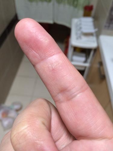 手上湿疹好多年了有时候会自动开裂皮