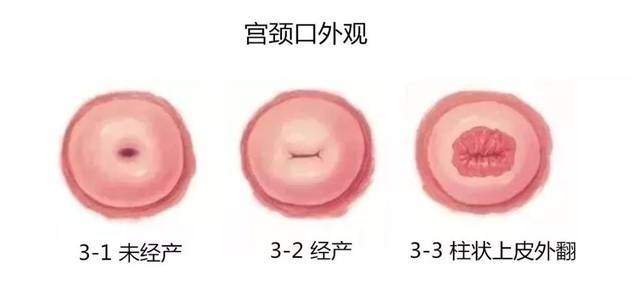 【高阳妇幼科普】"宫颈糜烂"——一个过时的诊断