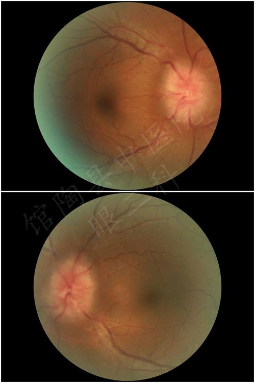 7 眼底检查是检查玻璃体,视网膜,脉络膜和视神经疾病的重要方法.