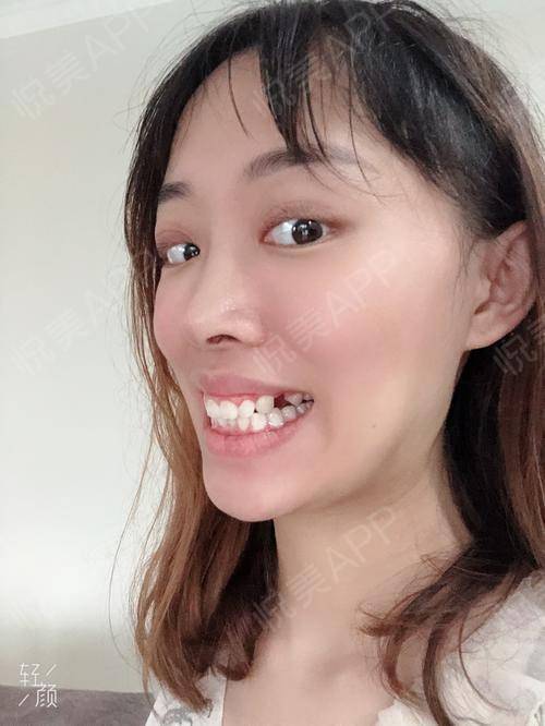 我牙齿比较凸是遗传的骨性龅牙