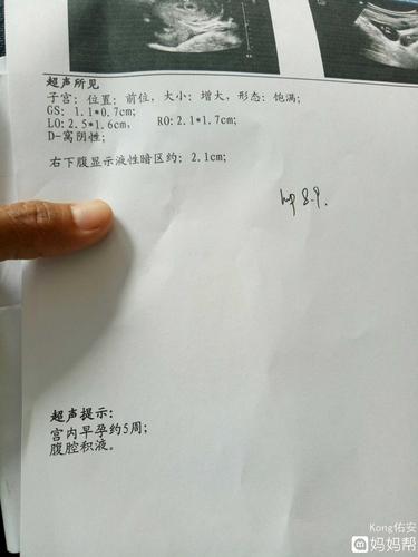 腹腔积液是什么东西