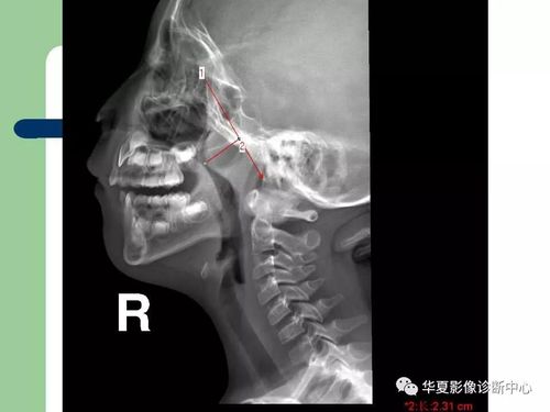 腺样体肥大的x线诊断