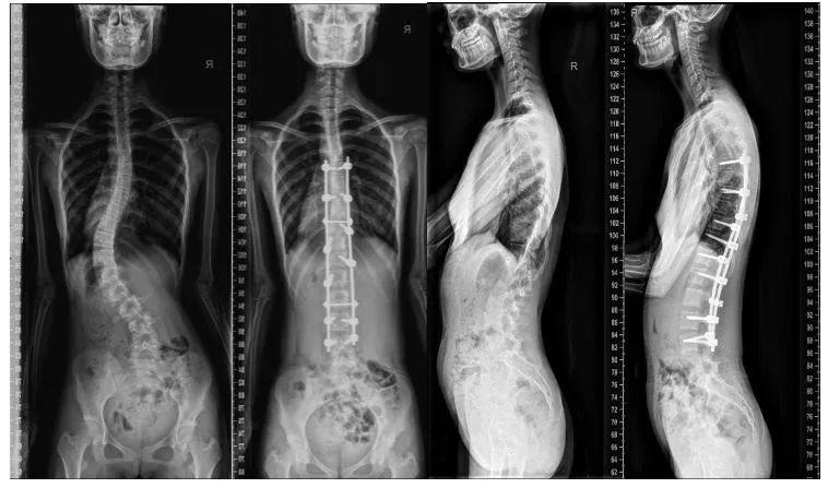 小心"成长杀手"脊柱侧弯,家长知道多少?
