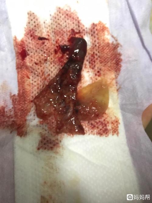 孕八周自然流产,请问大家这样流