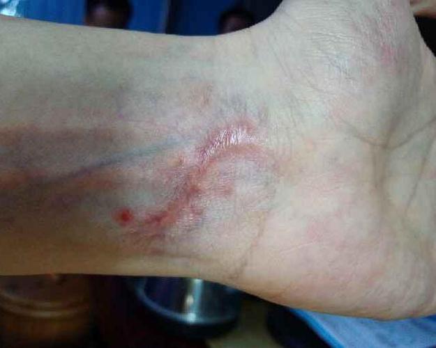 手腕处受伤后留下这个疤可以做吗,急