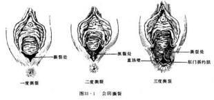 自然产后会阴裂伤伤口护理