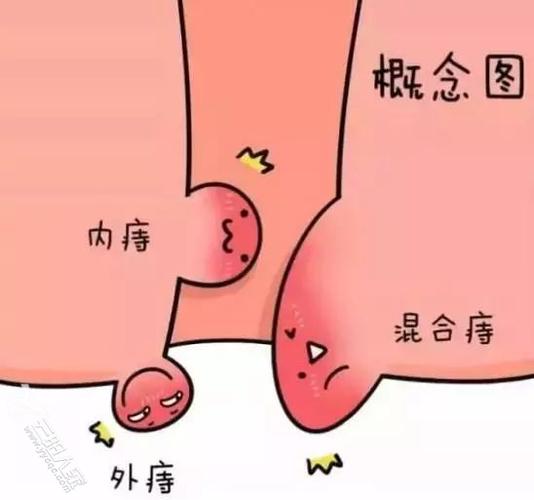 需要提醒的是,不但痔疮有大便带血的现象,肠息肉,结肠炎,直肠癌等