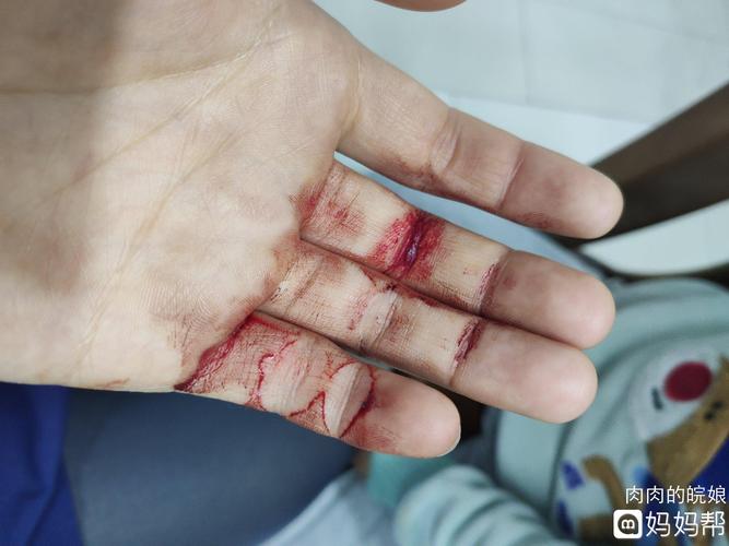 昨天被歹徒持刀抢劫割伤了手指,报了案警察