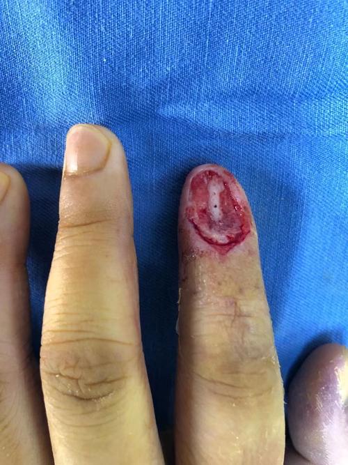 手术方式简单,局部麻醉下可进行,2.若甲根留存可再次有甲板生长3.