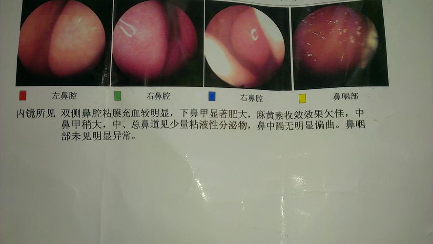 我得了鼻炎已经8年了期间吃过很多药都没有效果 去医院检查的说有粉尘