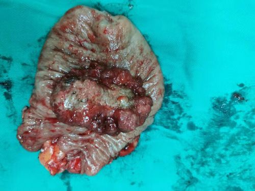 33岁便鲜血,痔疮出血?