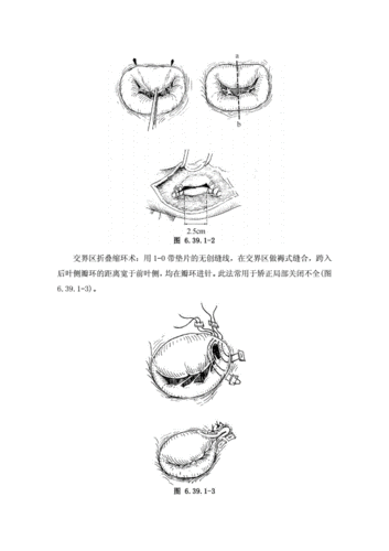 二尖瓣成形术.pdf