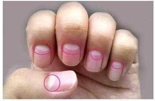 指甲月牙越大就越健康?这里告诉你