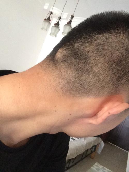 我后脑勺有一块骨头凸起,从小学就开始有了.理个短发