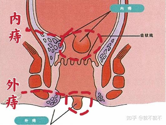 女生经历痔疮手术是怎样一种体验?