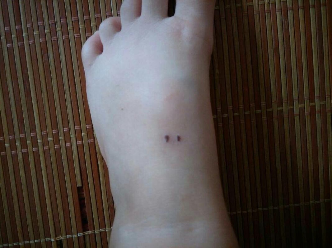 不确定宝宝脚上的伤口是不是被狗狗咬了怎么办,又过了