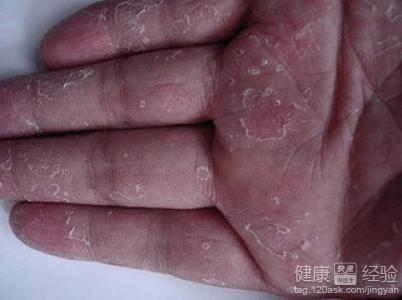汗疱疹适合做手术吗