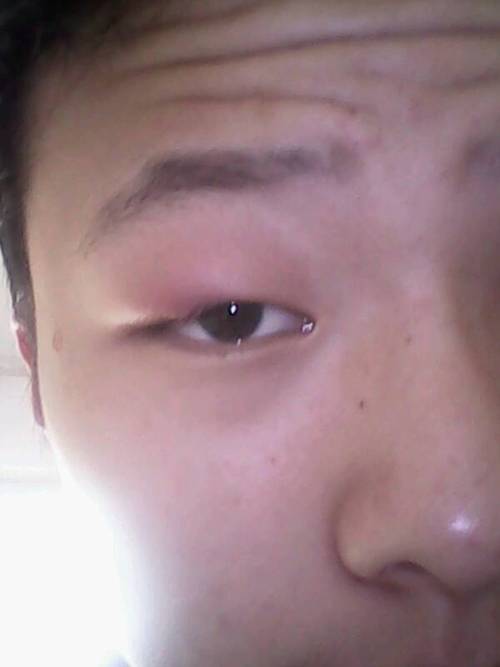 回答: 病情分析: 您好,您的情况属于眼睛发炎,一般是细菌感染,上火