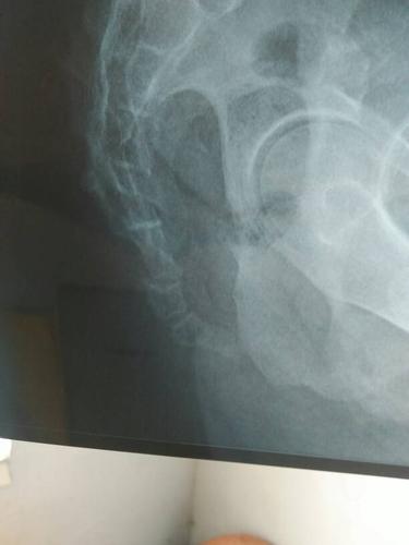 摔了个屁股蹲儿,尾巴骨疼,拍片显示尾骨远端骨皮质欠连续什么意思