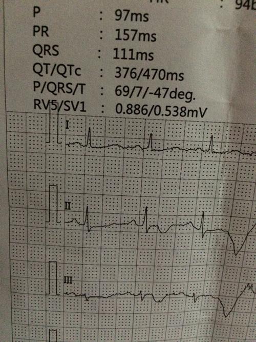 问:各位大神帮我看下这心电图值正常吗