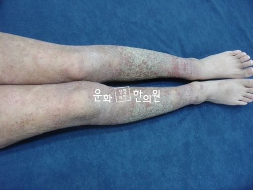 [转载]重症异位性皮炎