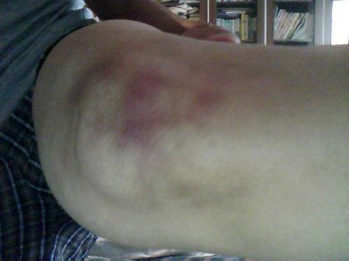 膝盖有红色像淤血一样的东西,有图,请问是什么问题