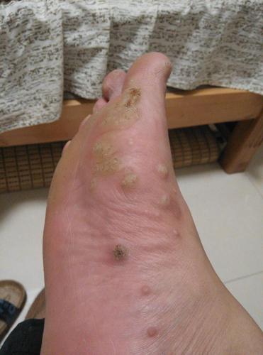跖疣,鱼休子,瘊子怎么有效治好,怎样对跖疣病毒的dna产生破坏