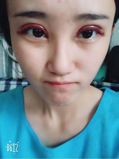 刚做的全切双眼皮 开眼角8mm,有点后悔感觉窄了