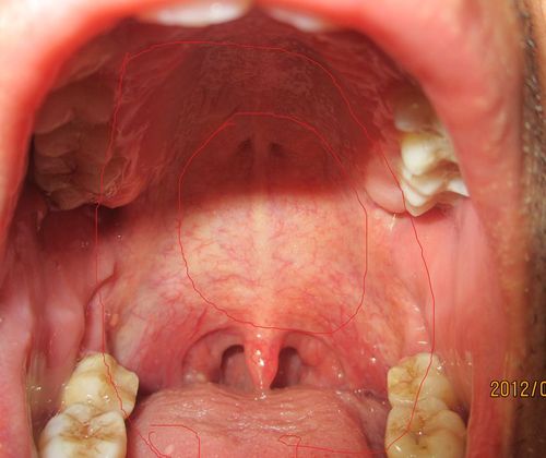 白喉,只是咽炎,给开了些治咽炎的药,吃了后感觉喉咙舒服多了,可这口腔